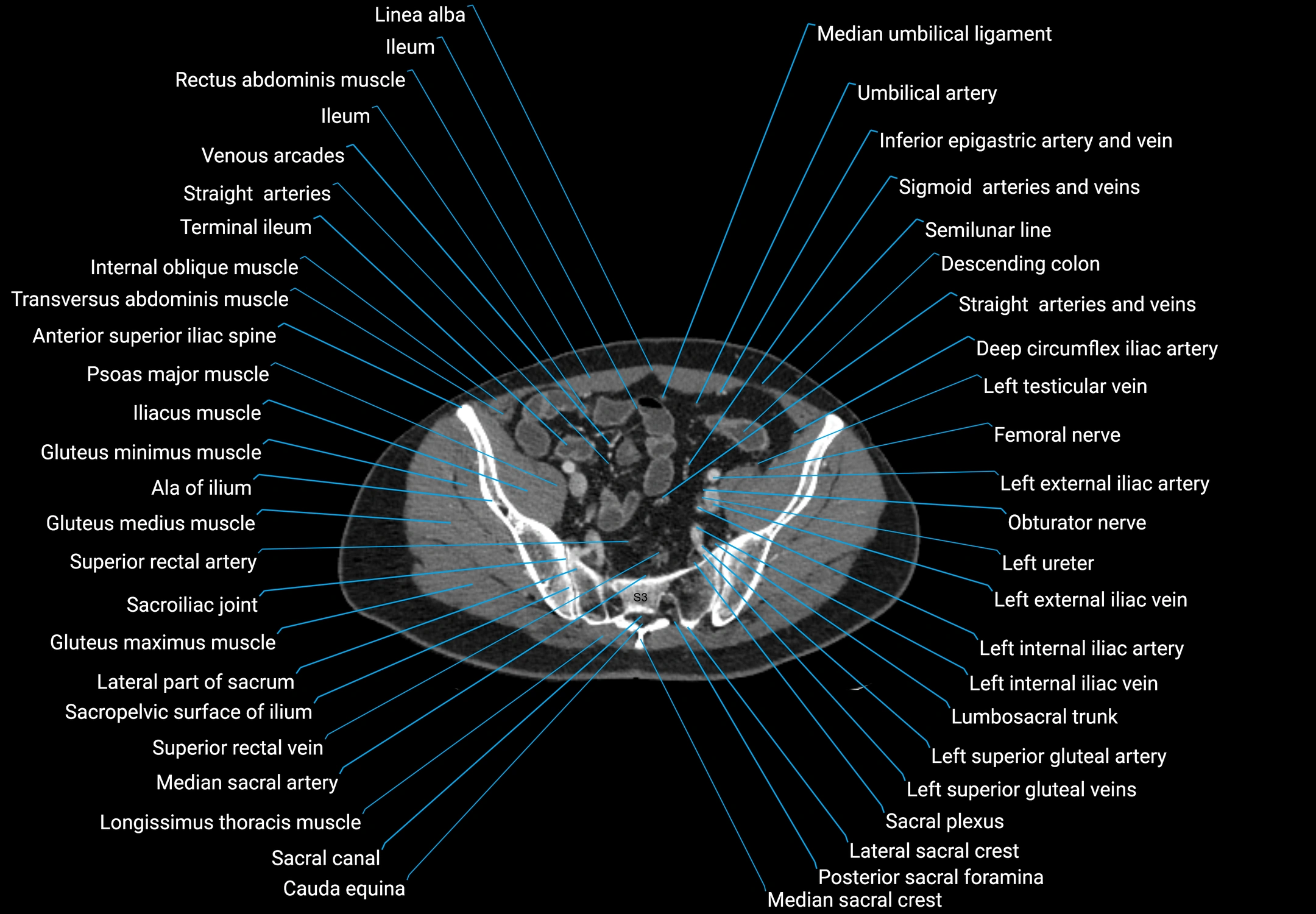 CT male pelvis axial cross sectional anatomy labelled radiology image -00155.webp
